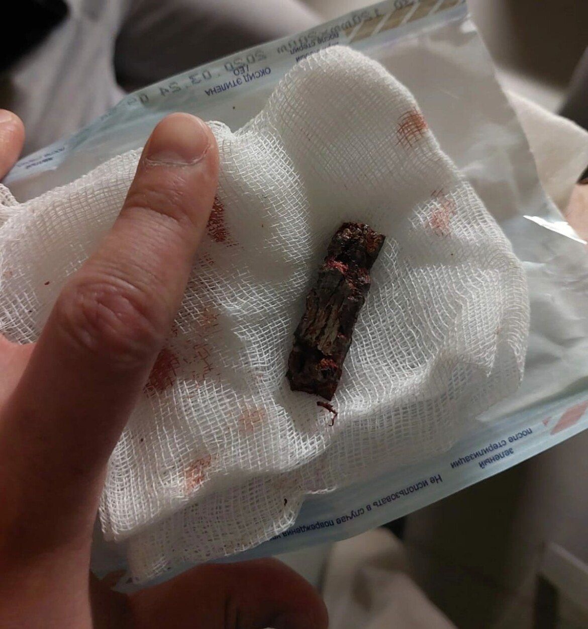 В Нижнекамске врачи чудом нашли осколок мины в шее бойца, раненого в зоне СВО