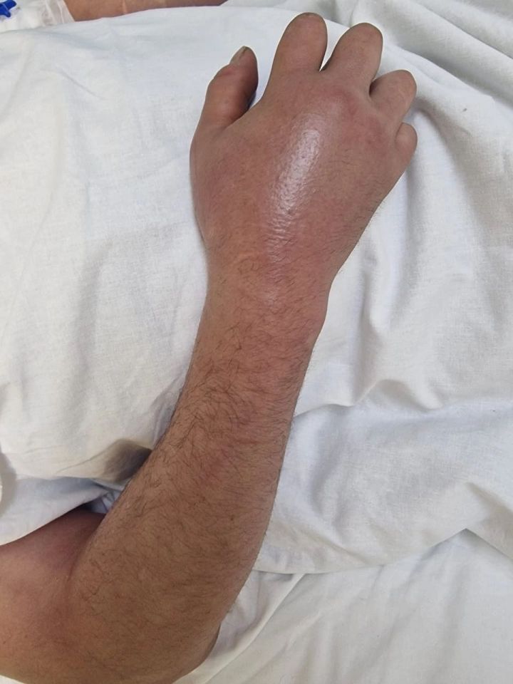 Челнинские врачи городской больницы №5 спасли руку мужчины от ампутации после укуса гадюки